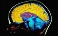 Experts warn of 'ticking timebomb' of cost of treating brain disorders - Telegraph | Hypnotherapy and Hypnosis | Scoop.it
