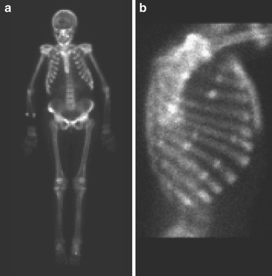 Bone pain and extremely low bone mineral density due to severe vitamin D deficiency in celiac disease | One child at a time | Scoop.it