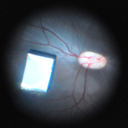 Retinal Implants Will Soon Fit Inside the Eye and Offer 20/20 Vision | MIT Technology Review | leapmind | Scoop.it