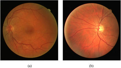 Retina Images Classification Based On D Empiri