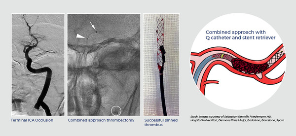 Mechanical Thrombectomy In Medium Vessel Occlus