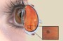 &lsquo;Freckles&rsquo; on his retina prompts a man to get himself tested for colon cancer | Buffy Hamilton's Unquiet Commonplace "Book" | Scoop.it