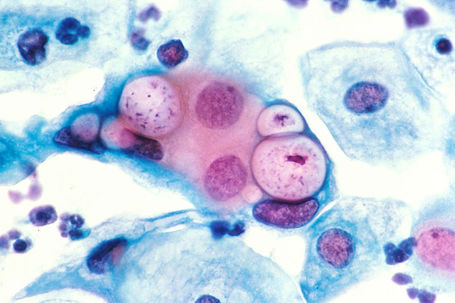 CHLAMYDIA TRACHOMATIS