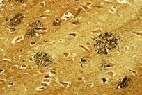 Is Alzheimer's Caused by Contagious Proteins? | Healthland | TIME.com | Medical News | Scoop.it