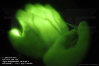 Perfuser de nuit sur le champ de bataille | Histoire de la M&eacute;decine et de la Chirurgie | Scoop.it