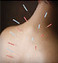 Acupuncture Pain Relief Is Real, Researchers Say | fitness, health&nutrition | Scoop.it