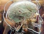 Il cervello trasparente come un cristallo | Malattie, cronicit&agrave;, cancro...vivere da cittadini della salute | Scoop.it
