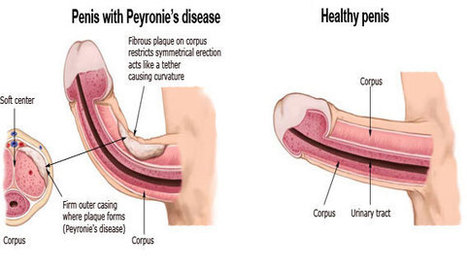 Steroids post injection pain