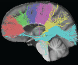 Brain imaging alone cannot diagnose autism | Special Needs News | Scoop.it