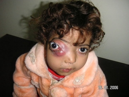What the US rape of Iraq did to its children - in pictures | EndGameWatch | Scoop.it