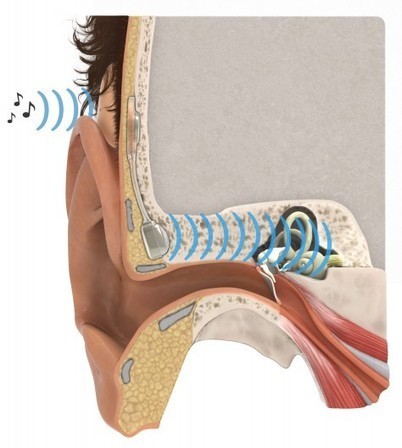 Implanted hearing aid uses bone conduction to bypass defective middle ear | Longevity science | Scoop.it