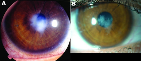 Lentes de contacto mal limpiados pueden generar f&aacute;bricas de virus | Salud Visual 2.0 | Scoop.it