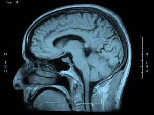 Teenage Brains Are Malleable And Vulnerable, Researchers Say : NPR | MMS Physical Science | Scoop.it