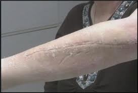 Second case of flesh-eating bacteria reported in South&nbsp;Carolina | T2M Network | Scoop.it