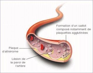 Le bon cholest&eacute;rol ne prot&eacute;gerait pas des maladies cardiovasculaires | Chair et M&eacute;tal - L'Humanit&eacute; augment&eacute;e | Scoop.it