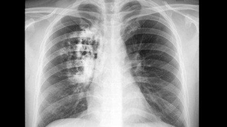 Potential for blood test to detect lung cancer in early stages | Longevity science | Scoop.it