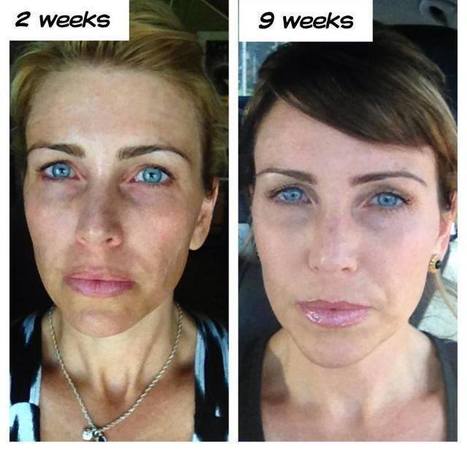 Remove stubborn pregnancy spots from your face with Rodan + Fields 
