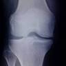 Bioidentical Hormones  Prevent and Reverse Osteoarthritis   by Jeffrey Dach MD