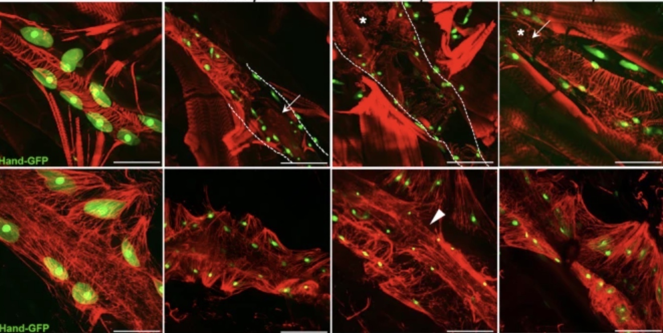 Cardiopathies congénitales une é