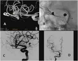 Endovascular Treatment Of Wide Neck Intracrania