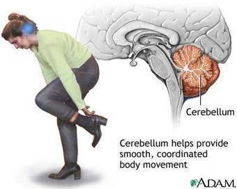 What You Should Know About Gluten Ataxia (Brain Damage from ... | Living Gluten free | Scoop.it