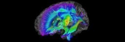 Autisme : l&rsquo;imagerie c&eacute;r&eacute;brale, une aide au diagnostic pr&eacute;coce&hellip; : Pour une approche plurielle et &eacute;thique des autismes | lesptitsloupstic: Actualit&eacute; et Autisme | Scoop.it
