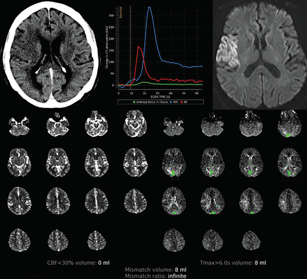 Rapid Automated Ct Perfusion In Clinical Practi