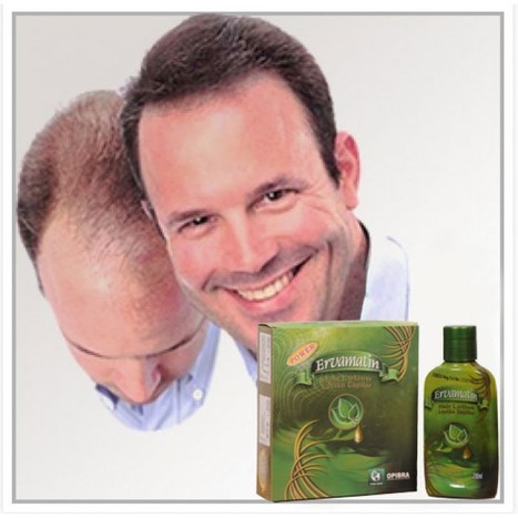 Best Hair Loss Treatment For Men | BEST ONLINE ...