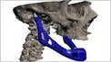 Transplant jaw made by 3D printer | healthinnovations | Scoop.it