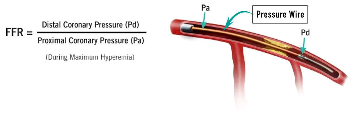 Fractional Flow Reserve Interventional Cardio