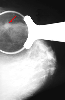 Screening Mammography Found Useless in New Study by Dr Jeffrey Dach MD | Bioidentical Hormones  Prevent and Reverse Osteoarthritis   by Jeffrey Dach MD | Scoop.it