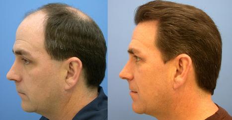 Image result for best hair transplant