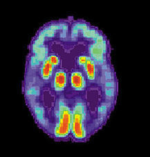 Without a Treatment, Why Test for Alzheimer's? | GeriPal - Geriatrics and Palliative Care Blog | Marketing connect&eacute; - Strat&eacute;gies d'influence autour des m&eacute;dias sociaux | Scoop.it