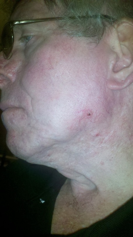Time to practice what I preach: I have skin cancer again | Salute 2.0 | Scoop.it