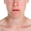 Summer Acne | Nature, and Natural products | Scoop.it