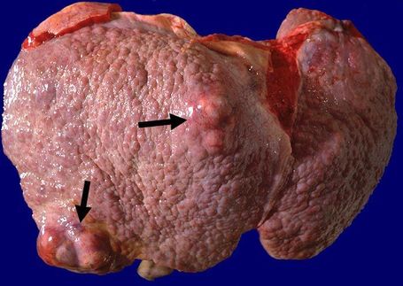 Les hépatocarcinomes sont provoqués dans 70% des cas par l'hepatite C | Microbiologie | Scoop.it