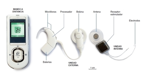 Resultado de imagen de implantes cocleares