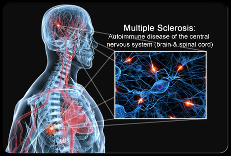 Multiple Sclerosis: Causes, Symptoms and Treatment | Scl&eacute;rose en Plaques | Scoop.it