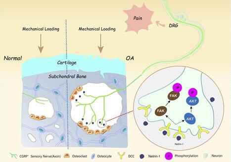 JCI - Subchondral bone osteoclasts induce sensory innervation and osteoarthritis pain | Rheumatology-Rhumatologie | Scoop.it