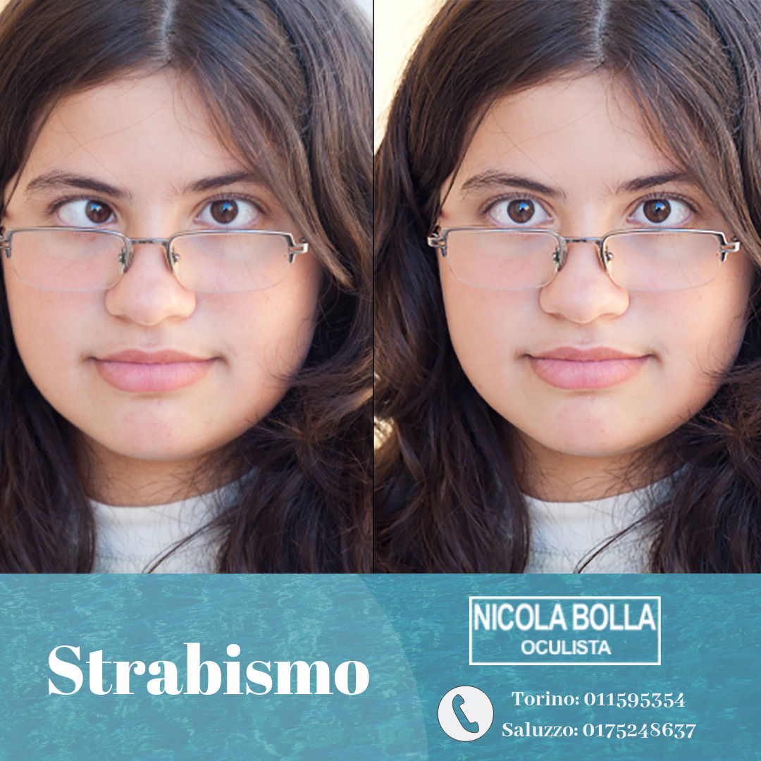 Strabismo Cause E Cura Oculista Torino Dr