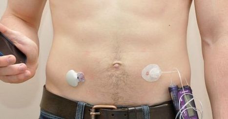 The World's First "Artificial Pancreas" Will Be Hitting the Market in 2017 | Temas selectos en endocrinología | Scoop.it