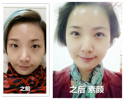 scarless double eyelid surgery