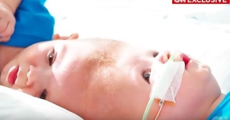 Kaksoset syntyivät päät kiinni toisissaan – katso lopputulos 27 tunnin leikkauksen jälkeen | 1Uutiset - Lukemisen tähden | Scoop.it