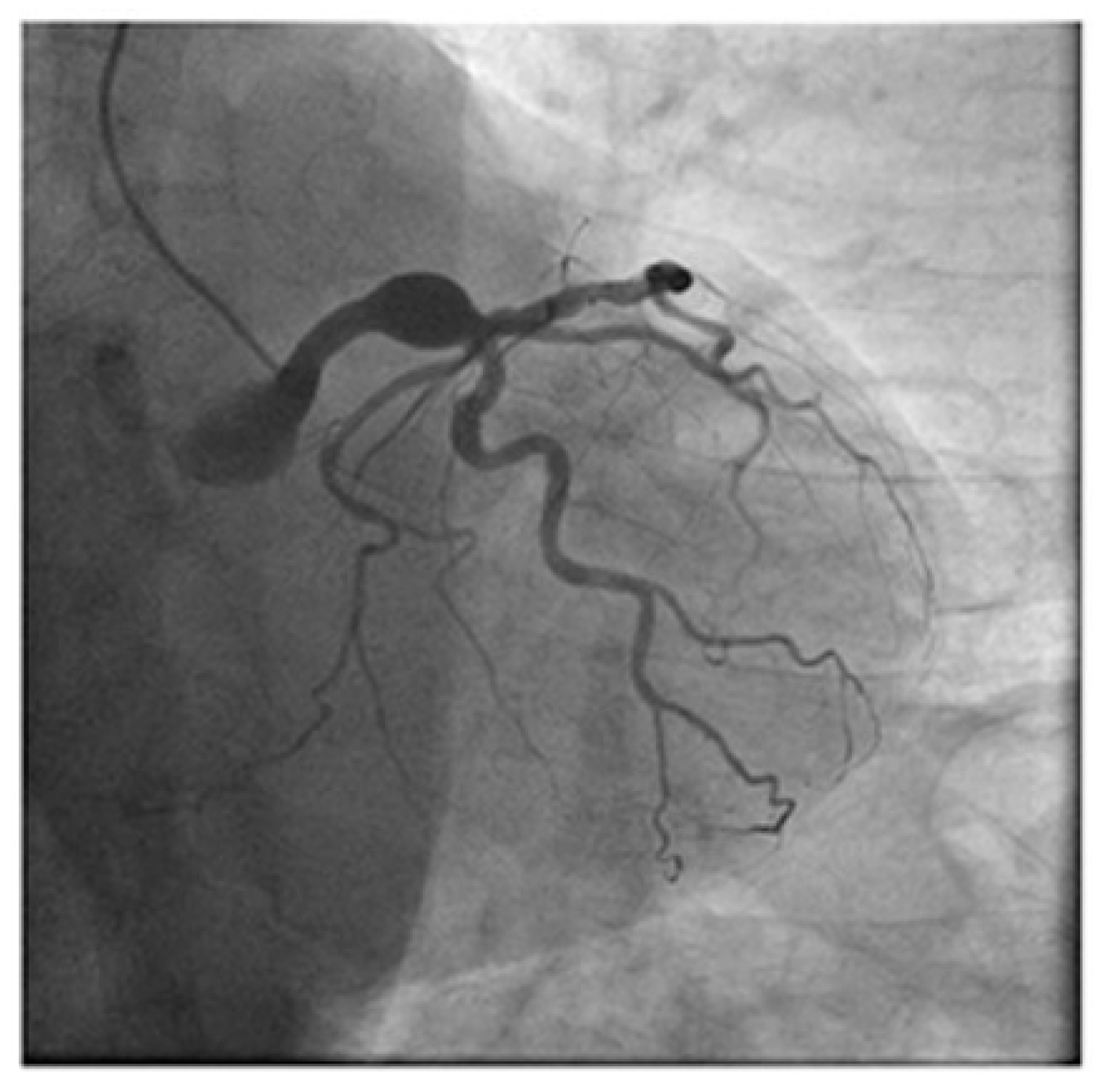 New Insights into the Pathophysiology of Corona...