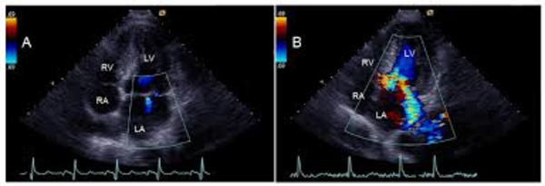 Trends in the Management of Anterior Mitral Leaflet Regurgitation | Transcatheter Treatment of Mitral Regurgitation | Scoop.it