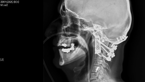 Man has 3D-printed vertebrae implanted in world-first surgery | 21st Century Innovative Technologies and Developments as also discoveries, curiosity ( insolite)... | Scoop.it