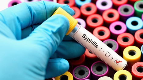 Au Pays de Galles, canicule et applis de rencontres responsables d'une hausse des cas de syphilis  - Top Santé | sida | Scoop.it