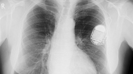 The pacemaker of the future might be made of heart cells | healthcare technology | Scoop.it