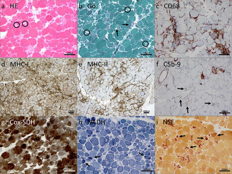 Anti-Ku + myositis: an acquired inflammatory protein-aggregate myopathy | Acta Neuropathologica | AUTOIMMUNITY | Scoop.it