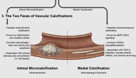 Coronary Artery Calcification: From Molecular Mechanisms to Interventional Strategies | Critical Limb-Threatening Ischemia (CLTI) | Scoop.it